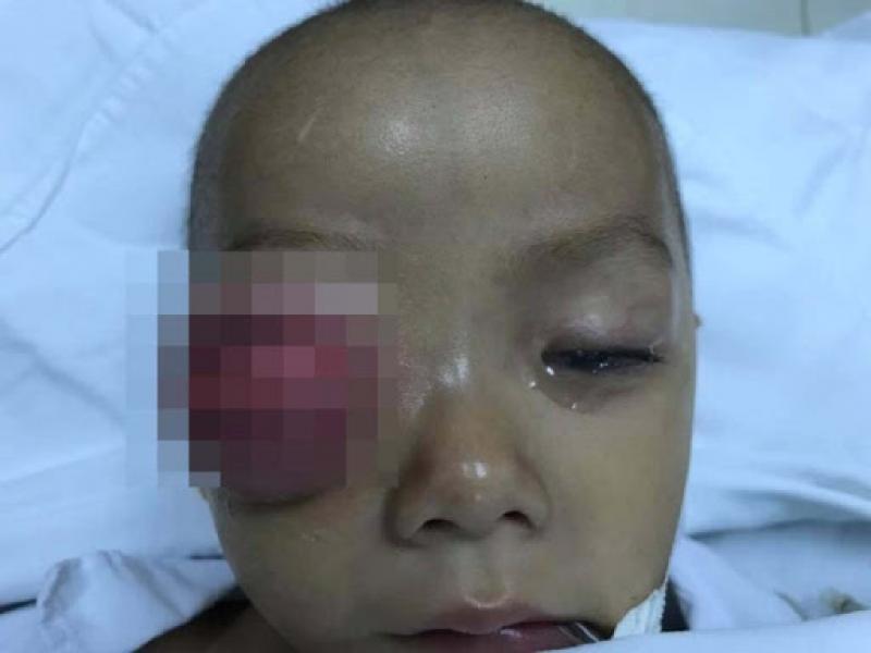 BÉ TRAI 2 TUỔI SUÝT MÙ MẮT BỞI BỆNH VIÊM XOANG