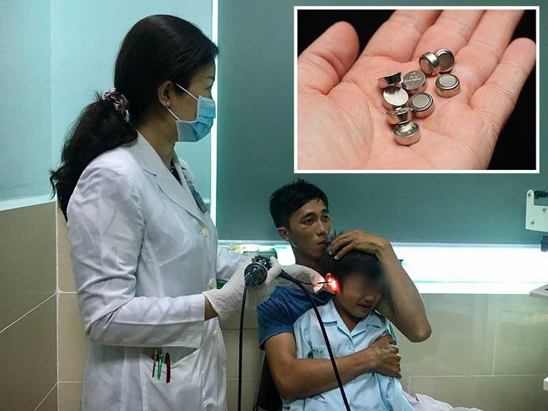 DỊ VẬT MŨI PIN ĐIỆN TỬ
