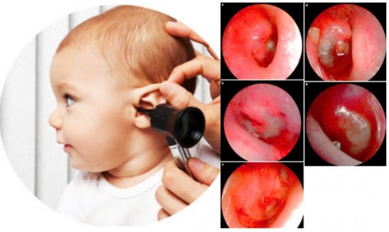 DẤU HIỆU CẢNH BÁO BỆNH TAI MŨI HỌNG Ở TRẺ NHỎ: CHA MẸ NÊN BIẾT.