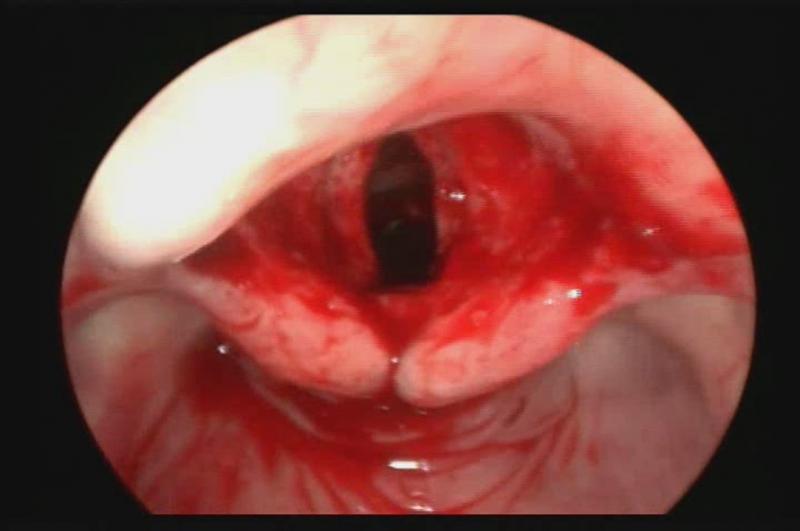 ĐIỀU TRỊ PAPILLOMA THANH KHÍ QUẢN
