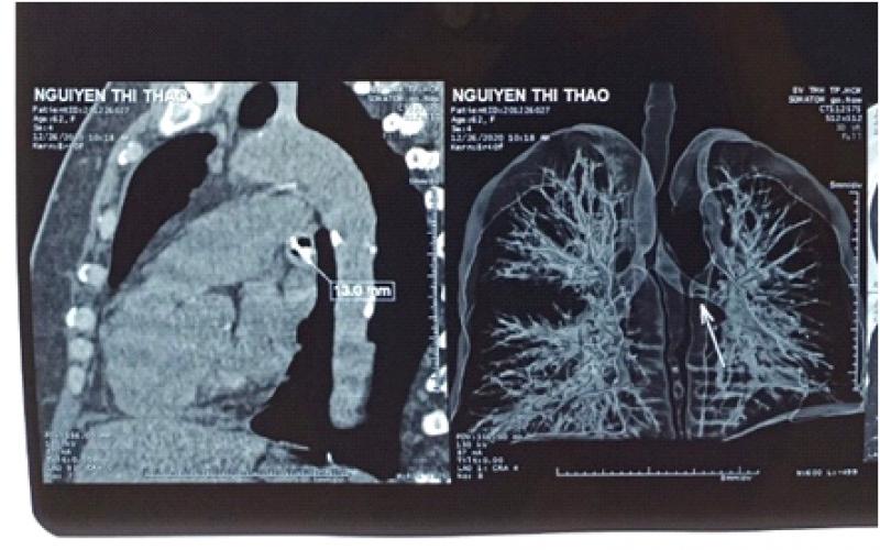 HY HỮU TRƯỜNG HỢP DỊ VẬT NGỦ QUÊN TRONG ĐƯỜNG THỞ