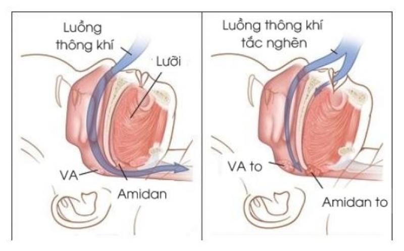 NGỦ NGÁY CHẲNG PHẢI CHUYỆN ĐÙA – PHÒNG KHÁM KỸ THUẬT CAO PHOENIX