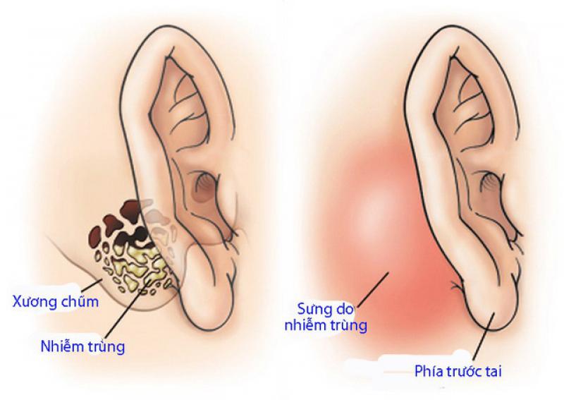 VIÊM TAI XƯƠNG CHŨM CÓ NGUY HIỂM?