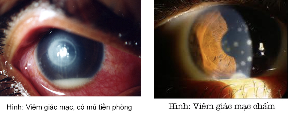ViÊm giÁc mẠc