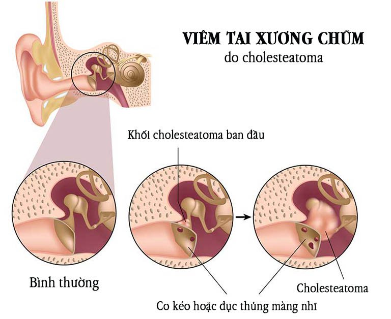 20200725 030325 207179 viem tai xuong chum max 1800x1800