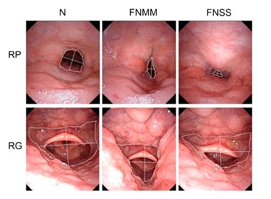 Ngủ ngáy chẳng phải chuyện đùa - phòng khám kỹ thuật cao phoenix