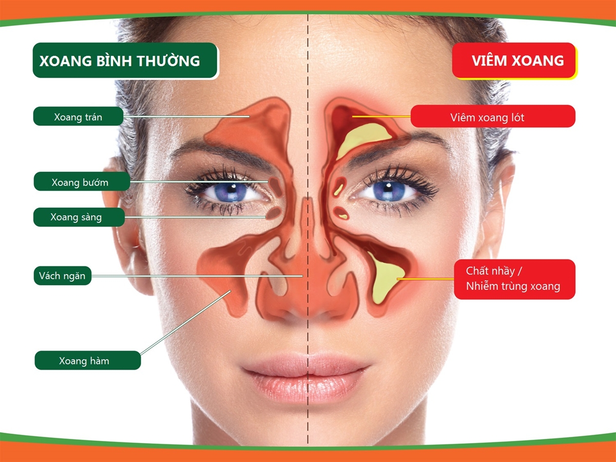 Benh tai mui hong khoi dau cua nhieu benh thongtinbenhcom1